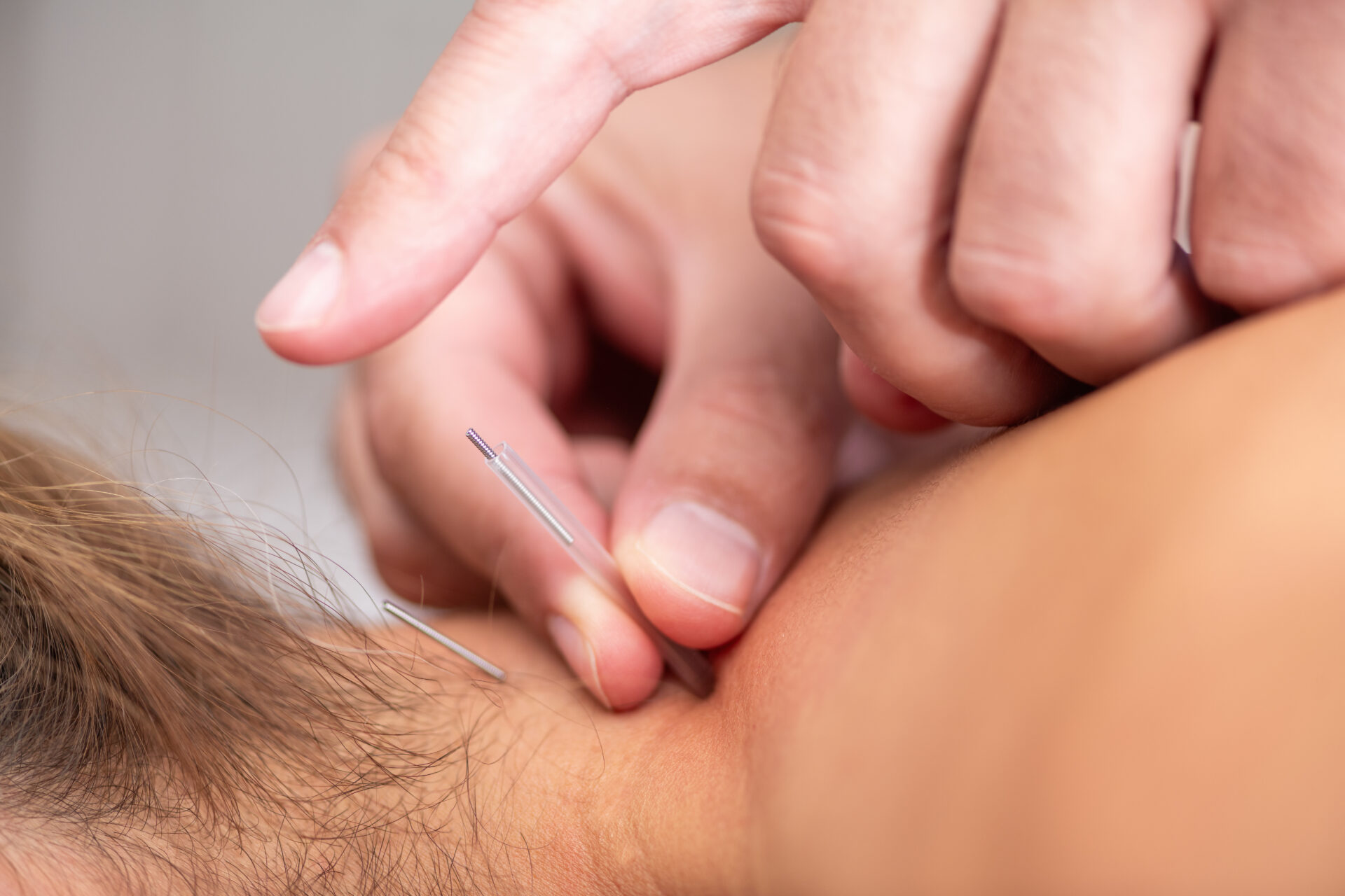 Physical therapist applying dry needling technique to a patients neck to relieve muscle tension, reduce pain, and enhance range of motion through precise trigger point therapy